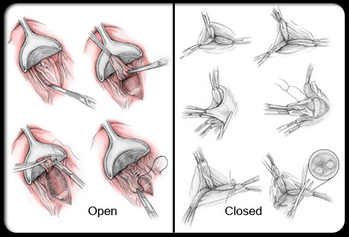 hemorrhoidectomy