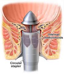 Hemorrhoids treatment