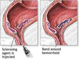 hemorrhoids treatment