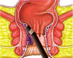 hemorrhoids heat coagulation