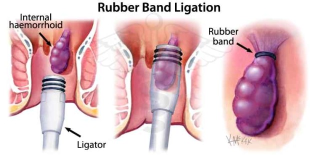 rubber band ligation